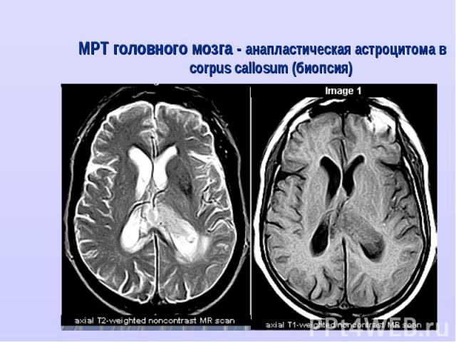 МРТ головного мозга - анапластическая астроцитома в corpus callosum (биопсия) МРТ головного мозга - анапластическая астроцитома в corpus callosum (биопсия)