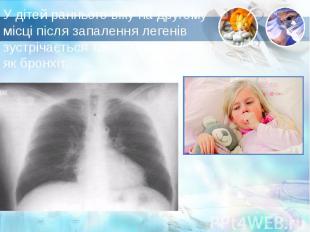 У дітей раннього віку на другому місці після запалення легенів зустрічається так