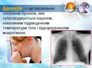 Бронхіт&nbsp;— це&nbsp;запалення оболонки бронхів, яке супроводжується кашлем, н