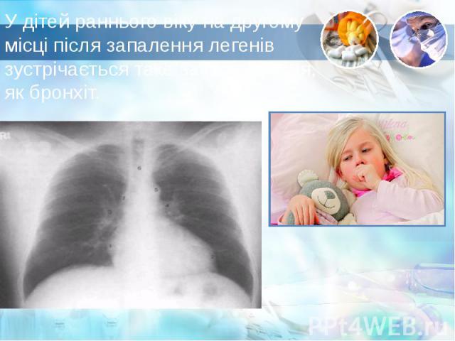 У дітей раннього віку на другому місці після запалення легенів зустрічається таке захворювання, як бронхіт.  У дітей раннього віку на другому місці після запалення легенів зустрічається таке захворювання, як бронхіт. 