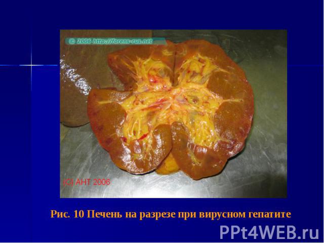 Рис. 10 Печень на разрезе при вирусном гепатите