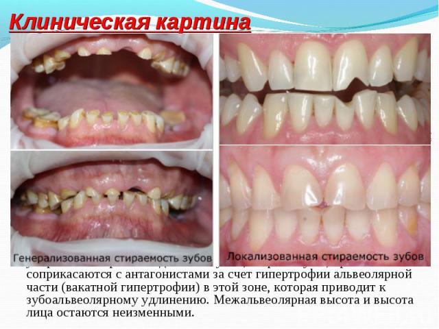 В зависимости от компенсаторно-приспособительной реакции зубочелюстной системы повышенную стираемость тканей зубов разделяют на следующие клинические варианты: В зависимости от компенсаторно-приспособительной реакции зубочелюстной системы повышенную…