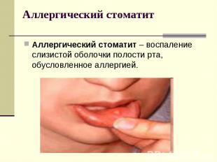 Аллергический стоматит – воспаление слизистой оболочки полости рта, обусловленно