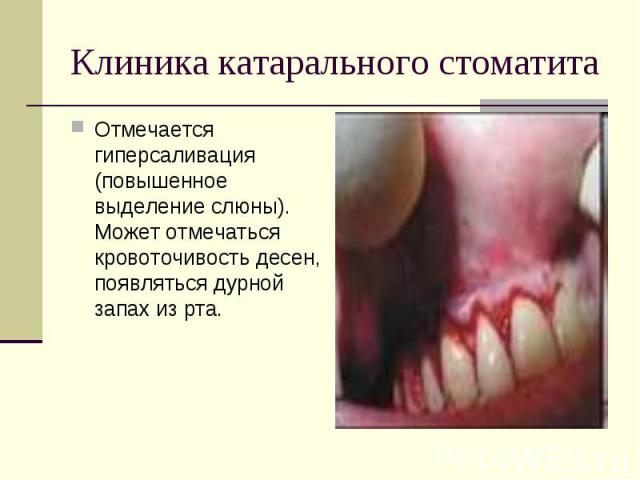 Отмечается гиперсаливация (повышенное выделение слюны). Может отмечаться кровоточивость десен, появляться дурной запах из рта. Отмечается гиперсаливация (повышенное выделение слюны). Может отмечаться кровоточивость десен, появляться дурной запах из рта.