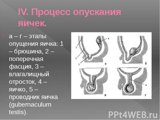 IV. Процесс опускания яичек.а – г – этапы опущения яичка: 1 – брюшина, 2 – поперечная фасция, 3 – влагалищный отросток, 4 – яичко, 5 – проводник яичка (gubernaculum testis).