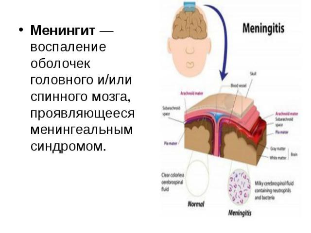 Менингит — воспаление оболочек головного и/или спинного мозга, проявляющееся менингеальным синдромом.Менингит — воспаление оболочек головного и/или спинного мозга, проявляющееся менингеальным синдромом.