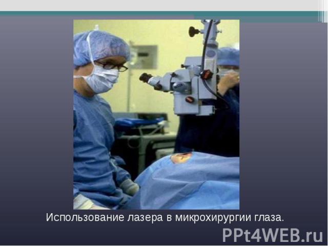 Использование лазера в микрохирургии глаза.