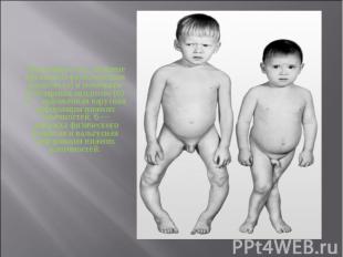 Мальчики 6 лет, больные витамин-D-резистентным рахитом (а) и почечным тубулярным