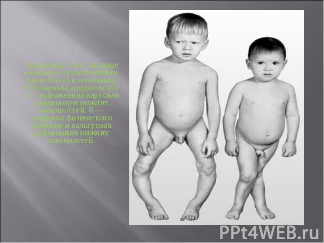 Мальчики 6 лет, больные витамин-D-резистентным рахитом (а) и почечным тубулярным ацидозом (б): а — выраженная варусная деформация нижних конечностей; б — задержка физического развития и вальгусная деформация нижних конечностей.