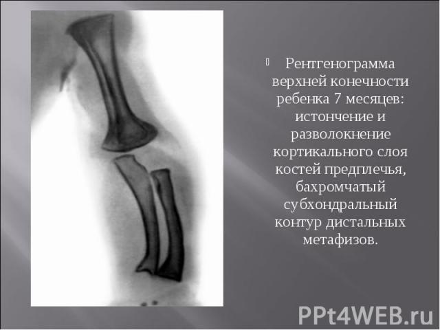 Рентгенограмма верхней конечности ребенка 7 месяцев: истончение и разволокнение кортикального слоя костей предплечья, бахромчатый субхондральный контур дистальных метафизов.