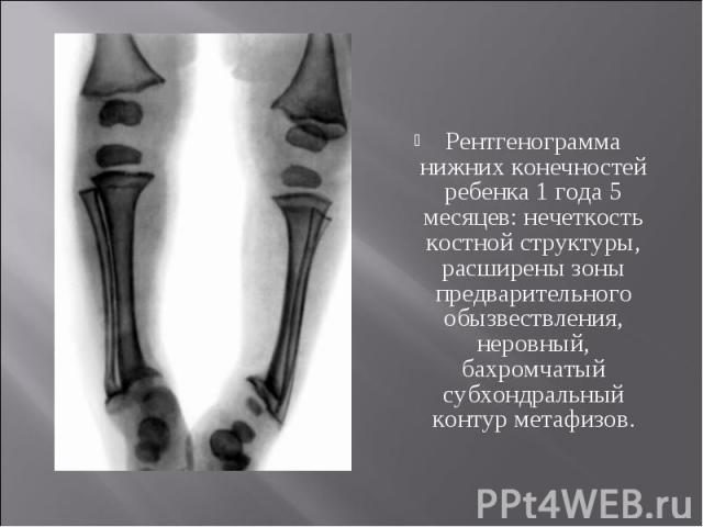 Рентгенограмма нижних конечностей ребенка 1 года 5 месяцев: нечеткость костной структуры, расширены зоны предварительного обызвествления, неровный, бахромчатый субхондральный контур метафизов.