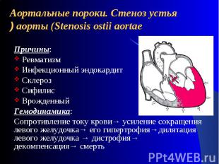 Аортальные пороки. Стеноз устья аорты (Stenosis ostii aortae ) Причины: Ревматиз