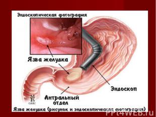 Лечение язвенной болезни желудка и двенадцатиперстной кишки презентация