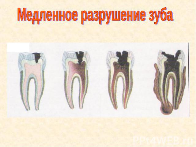 Медленное разрушение зуба