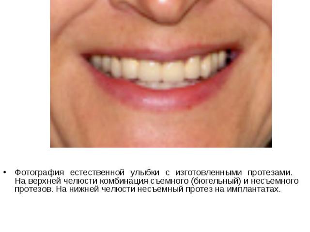 Фотография естественной улыбки с изготовленными протезами. На верхней челюсти комбинация съемного (бюгельный) и несъемного протезов. На нижней челюсти несъемный протез на имплантатах. 