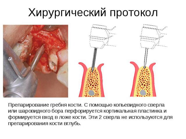 Хирургический протоколПрепарирование гребня кости. С помощью копьевидного сверла или шаровидного бора перфорируется кортикальная пластинка и формируется вход в ложе кости. Эти 2 сверла не используются для препарирования кости вглубь.