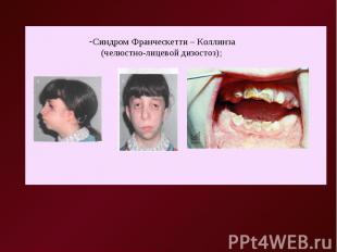 Синдром Франческетти – Коллинза (челюстно-лицевой дизостоз);