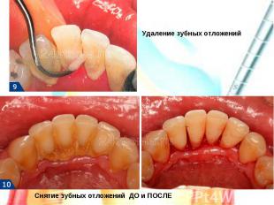 Удаление зубных отложенийСнятие зубных отложений ДО и ПОСЛЕ