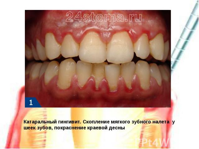 Катаральный гингивит. Скопление мягкого зубного налета у шеек зубов, покраснение краевой десны