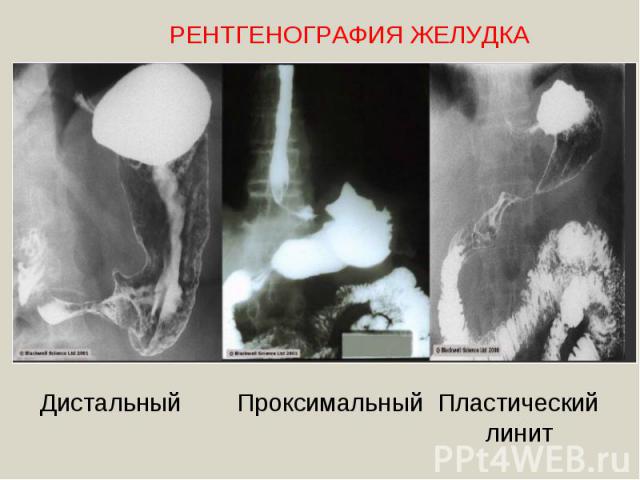 РЕНТГЕНОГРАФИЯ ЖЕЛУДКАДистальный Проксимальный Пластический линит