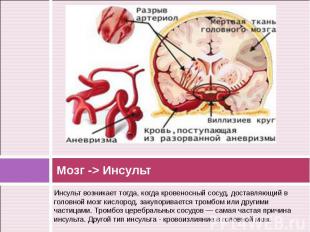 Инсульт возникает тогда, когда кровеносный сосуд, доставляющий в головной мозг к
