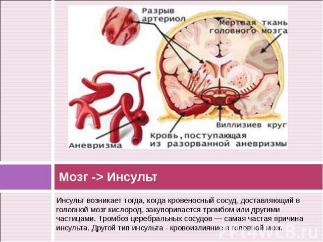 Инсульт возникает тогда, когда кровеносный сосуд, доставляющий в головной мозг кислород, закупоривается тромбом или другими частицами. Тромбоз церебральных сосудов — самая частая причина инсульта. Другой тип инсульта - кровоизлияние в головной мозг.…