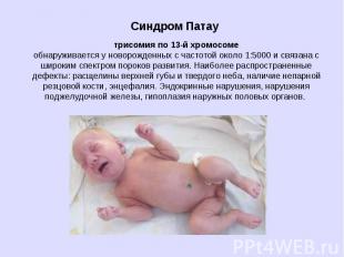 Синдром Патау трисомия по 13-й хромосоме обнаруживается у новорожденных с частот