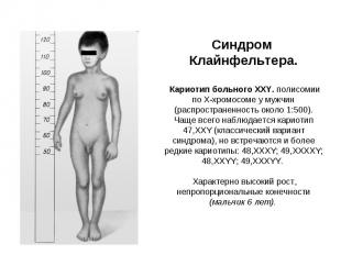 Синдром Клайнфельтера. Кариотип больного XXY. полисомии по X-хромосоме у мужчин