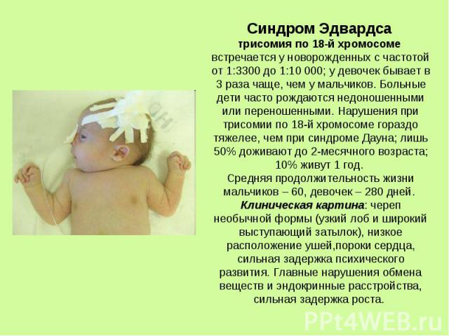 Синдром Эдвардса трисомия по 18-й хромосоме встречается у новорожденных с частотой от 1:3300 до 1:10 000; у девочек бывает в 3 раза чаще, чем у мальчиков. Больные дети часто рождаются недоношенными или переношенными. Нарушения при трисомии по 18-й х…
