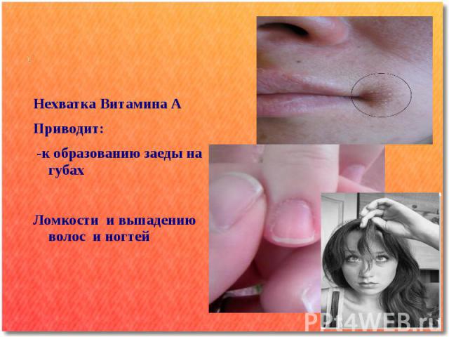 Нехватка Витамина А Приводит: -к образованию заеды на губах Ломкости и выпадению волос и ногтей