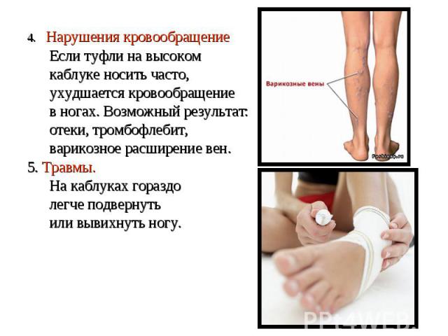 4. Нарушения кровообращение Если туфли на высоком каблуке носить часто, ухудшается кровообращение в ногах. Возможный результат: отеки, тромбофлебит, варикозное расширение вен. 5. Травмы. На каблуках гораздо легче подвернуть или вывихнуть ногу.