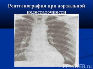 Рентгенография при аортальной недостаточности