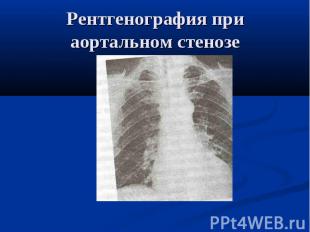 Рентгенография при аортальном стенозе