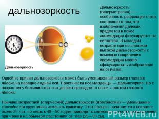дальнозоркость Дальнозоркость (гиперметропия) — особенность рефракции глаза, сос