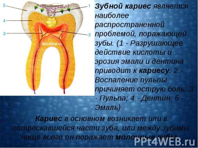 Зубной кариес является наиболее распространенной проблемой, поражающей зубы. (1 - Разрушающее действие кислоты и эрозия эмали и дентина приводит к кариесу; 2 - Воспаление пульпы причиняет острую боль; 3 - Пульпа; 4 - Дентин; 5 - Эмаль) Кариес в осно…