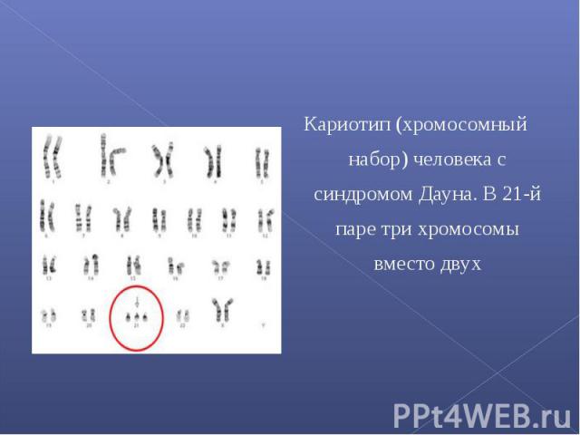 Кариотип (хромосомный набор) человека с синдромом Дауна. В 21-й паре три хромосомы вместо двух