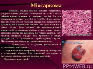 Міосаркома Злоякісна пухлина м'язової тканини. Розрізняють рабдоміосаркому (похо
