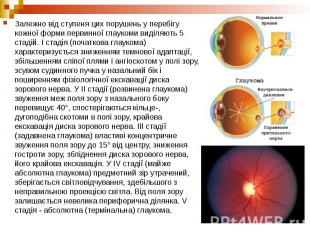 Залежно від ступеня цих порушень у перебігу кожної форми первинної глаукоми виді