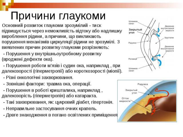 Причини глаукоми Основний розвиток глаукоми зрозумілий - тиск підвищується через неможливість відтоку або надлишку вироблення рідини, а причини, що викликають порушення механізмів циркуляції рідини не зрозумілі. З виявлених причин розвитку глаукоми …