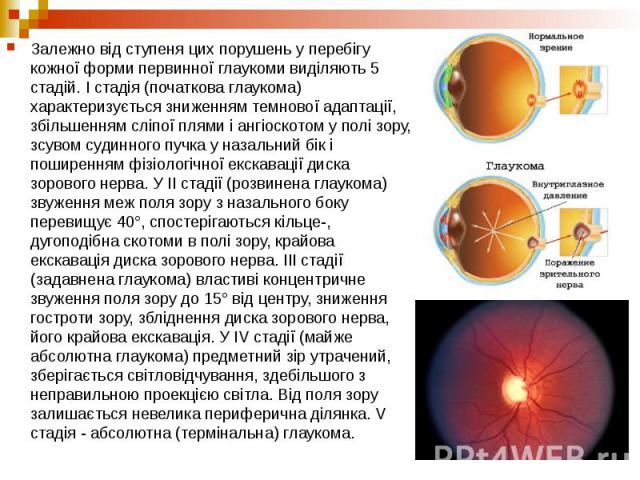 Залежно від ступеня цих порушень у перебігу кожної форми первинної глаукоми виділяють 5 стадій. І стадія (початкова глаукома) характеризується зниженням темнової адаптації, збільшенням сліпої плями і ангіоскотом у полі зору, зсувом судинного пучка у…