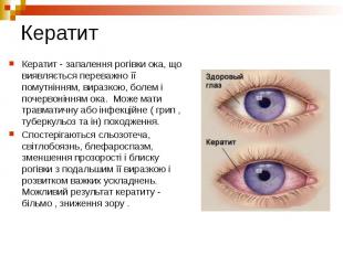 Кератит Кератит - запалення рогівки ока, що виявляється переважно її помутнінням