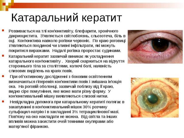 Катаральний кератит Розвивається на тлі кон'юнктивіту, блефарити, хронічного дакриоцистита. З'являється світлобоязнь, сльозотеча, біль в оці. Кон'юнктива навколо рогівки червоніє. По краю роговиці з'являються поодинокі чи зливні інфільтрати, які мож…