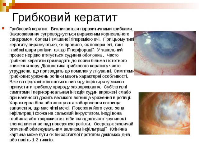 Грибковий кератит Грибковий кератит. Викликається паразитичними грибками. Захворювання супроводжується вираженим корнеального синдромом, болем і змішаної гіперемією очі. При цьому типі кератиту виразкуються, як правило, як поверхневі, так і глибокі …
