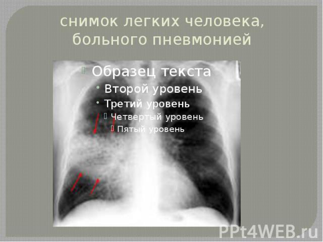 снимок легких человека, больного пневмонией