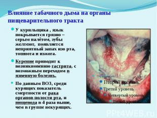 Влияние табачного дыма на органы пищеварительного тракта У курильщика , язык пок