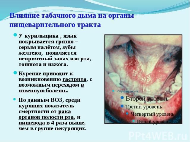 Влияние табачного дыма на органы пищеварительного тракта У курильщика , язык покрывается грязно – серым налётом, зубы желтеют, появляется неприятный запах изо рта, тошнота и изжога.Курение приводит к возникновению гастрита, с возможным переходом в я…