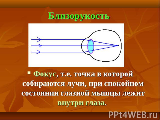 Близорукость Фокус, т.е. точка в которой собираются лучи, при спокойном состоянии глазной мышцы лежит внутри глаза.