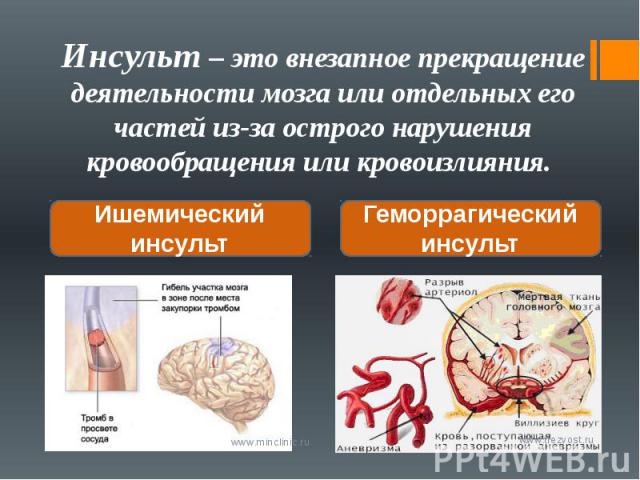 Инсульт – это внезапное прекращение деятельности мозга или отдельных его частей из-за острого нарушения кровообращения или кровоизлияния.