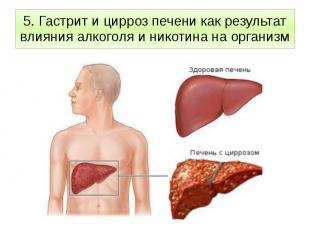 5. Гастрит и цирроз печени как результат влияния алкоголя и никотина на организм