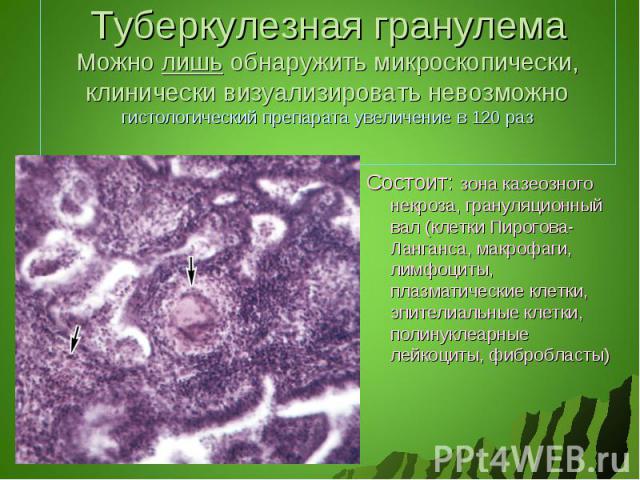 Туберкулезная гранулемаМожно лишь обнаружить микроскопически, клинически визуализировать невозможногистологический препарата увеличение в 120 раз Состоит: зона казеозного некроза, грануляционный вал (клетки Пирогова-Ланганса, макрофаги, лимфоциты, п…